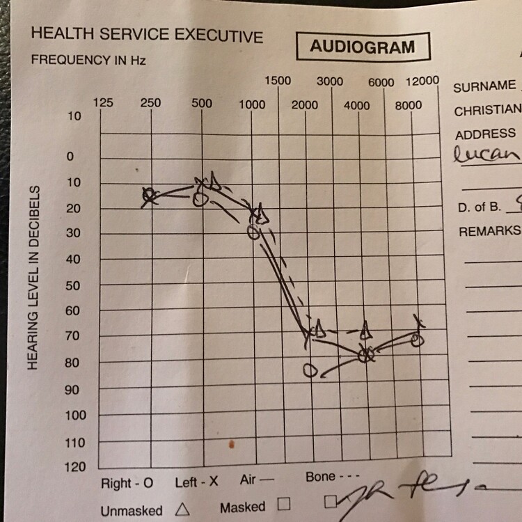 How To Treat High Frequency Hearing Loss