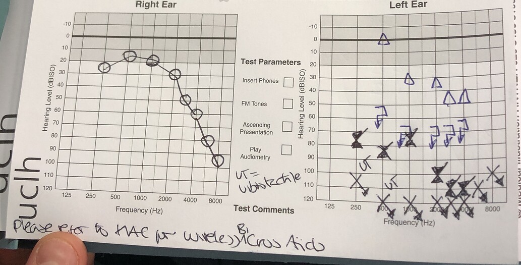 what-do-the-triangle-s-mean-on-this-photo-of-my-audiogram-hearing-aid-forum-active-hearing