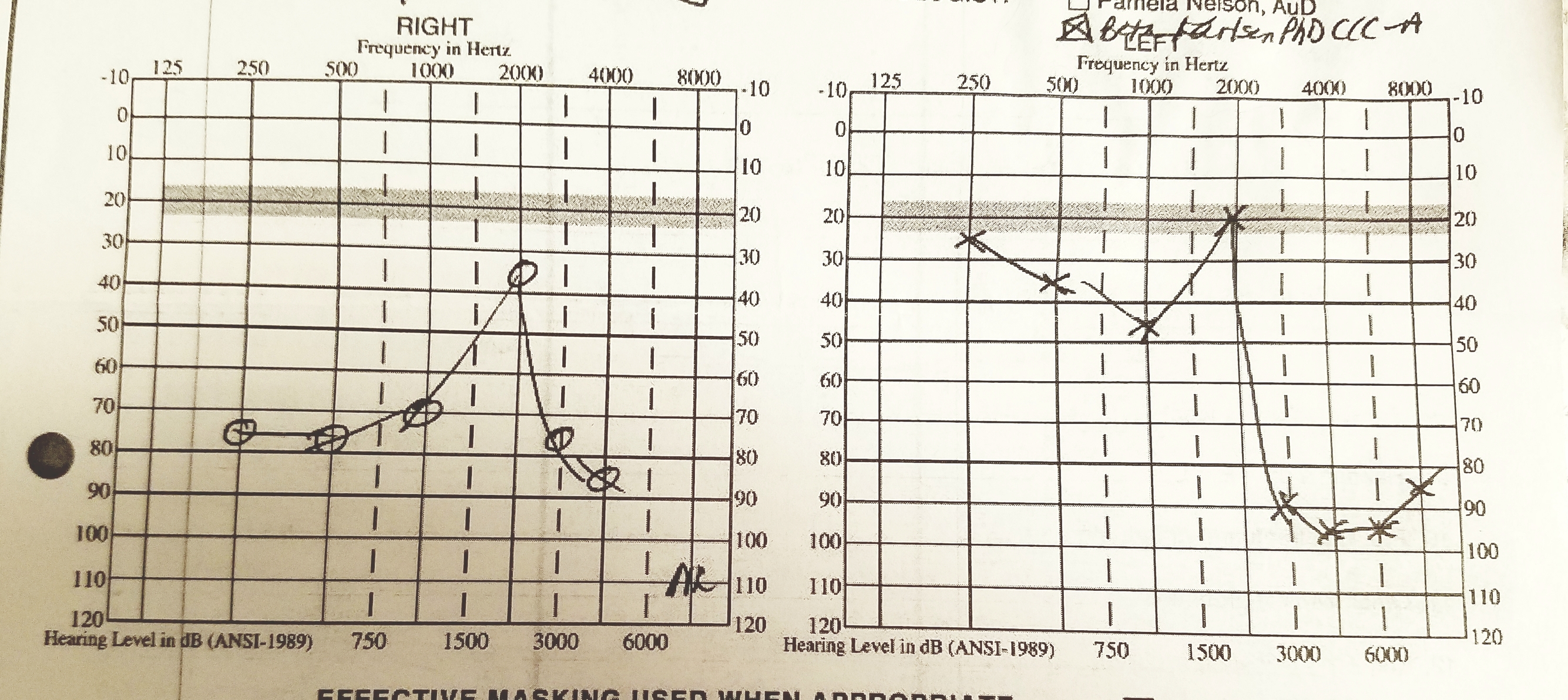 How To Read An Audiogram Asha Audiogram Matching In Hearing Aid Using