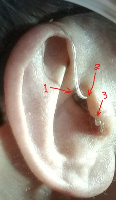 20190423_Left%20Ear%20Mold%20In%20Place